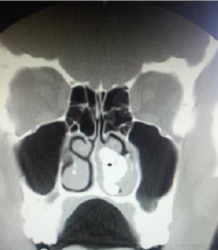 97 sufficient, although open surgical techniques may also be needed when complications such as septal or antral perforation are observed.