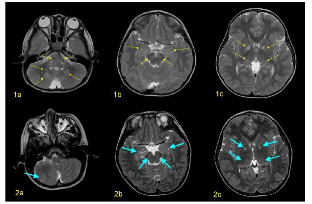 MRG n=172 23 Epilepsi+/149 Epilepsi NBO %69.6 vs %72.54 Intrakranial tümör +, n=11 4/11 (%36) Epilepsi Intrakranial Tümör-, n=161 19/161 (%11.