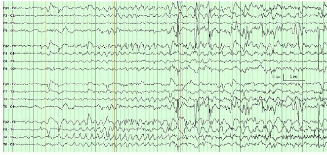 4/6 MTS dirençli epilepsi, 3/4 epilepsi cerrahisi,