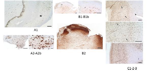 (NF1+MTS ilişkili dirençli epilepsi) epilepsi