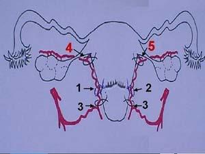 Adım Adım Uterin Devaskülarizasyon 1- Unilateral uterin