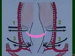 segment uterin arter ligasyonu 4-Unilateral ovarian arter