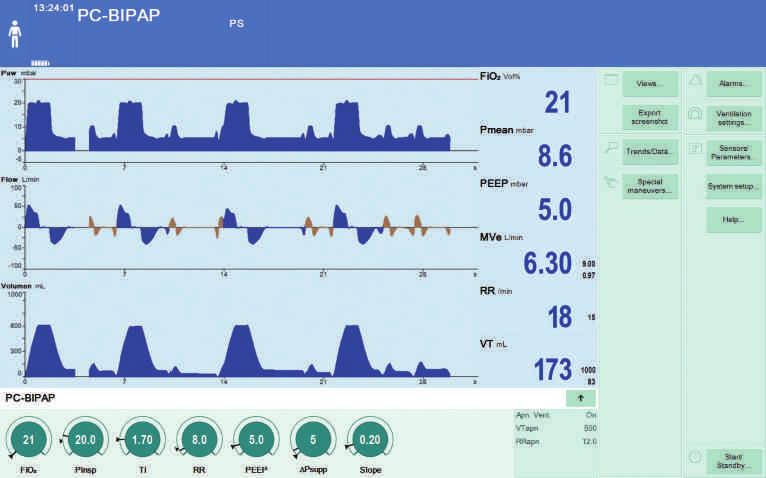 PC-BIPAP VE PC-AC 5 PC-BIPAP ile zorunlu solukların sayısı önceden ayarlanmış durumdayken hasta herhangi bir anda spontan soluyabilir.