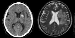Tanı Görüntüleme: NKBT veya MR Ayırıcı tanı Komplikasyonların tespiti Ventriküler hemoraji Beyin ödemi Hidrosefali http://emedicine.medscape.