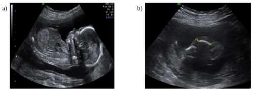 Prenatal dönemde saptanan Tanatoforik Displazi