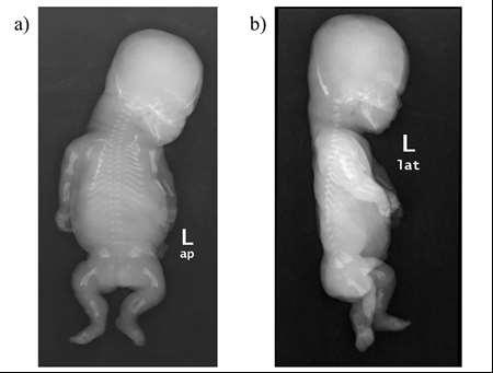 Fetusa ait obstetrik ultrasonografi görüntüleri: a)