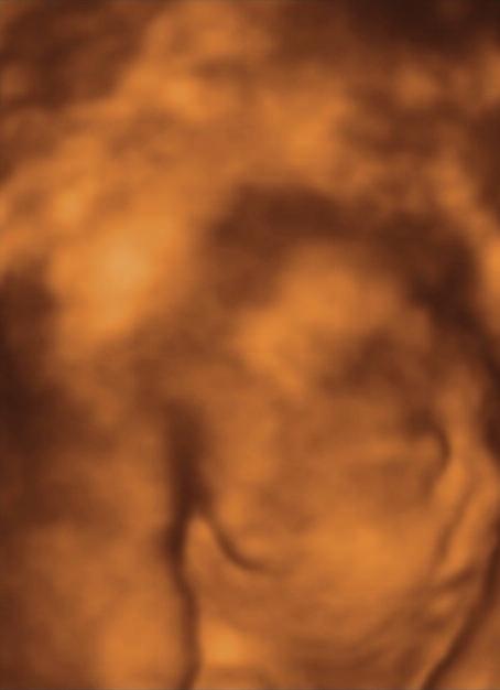 AKONDROGENEZİ TİP IA (HOUSTON-HARRIS): 2D/3D/4D ULTRASONOGRAFİ İLE PRENATAL TANI Alin BAŞGÜL YİĞİTER ve ark.