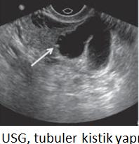 HSG de peritoneal dağılım olmaması ve genişlemiş tuba izlenir.