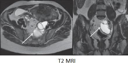 Hidrosalpinx MRI: adnekste normal görünen overden faklı tubuler yapı izlenir.