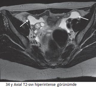 Peritoneal inklüzyon kisq MRI kompleks vakalarda yararlı olabilir Genelikle basit sıvı