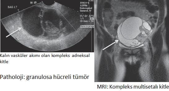 Over tümörleri Epitelyal, germ hücreli, sex- cord stromal Benign, borderline, malign MetastaQk Genç