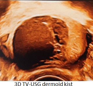 Matur kisqk teratom (dermoid kist) En sık germ hücreli tümördür En az 2-3 embryonik germ hücre tabakasına