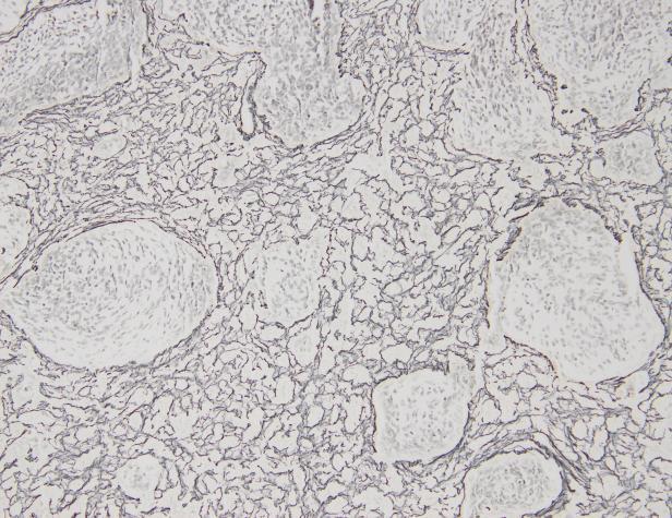 Nodüller içinde olgunlaşan veya olgun ganglion hücreleri bulunabilir. Bunun aksine, internodüler doku daha az farklılaşmış, daha pleomorfik ve daha proliferatiftir.