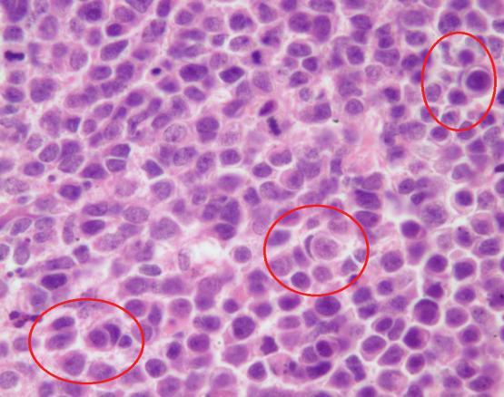 11 2.2.4. Büyük Hücreli / Anaplastik medulloblastom Bu lezyonlar, yüksek derecede sitolojik atipi ve daha büyük hücre boyutu ile klasik medulloblastomdan farklıdır.