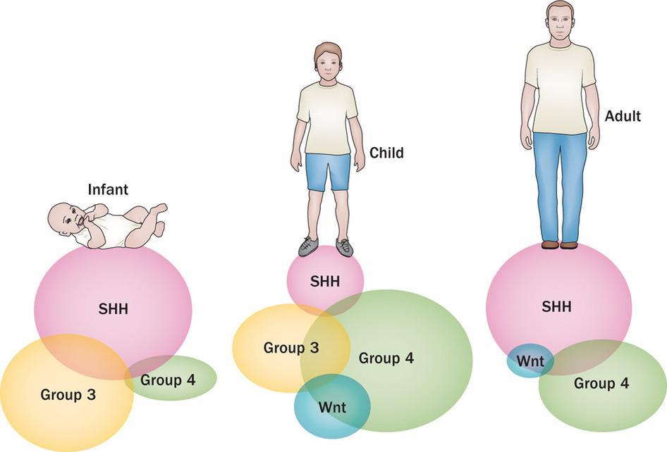 16 2.3.4. WNT/SHH yolağı aktif olmayan grup 4 medulloblastom Bu grup tümörler tüm medulloblastomların %40 ını oluşturmaktadır. 5-15 yaş arası çocukluk dönemi en sık izlendiği dönemdir.
