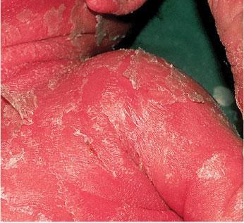 haşlanmış deri sendromu (SSSS) Bebeklerde görülen,