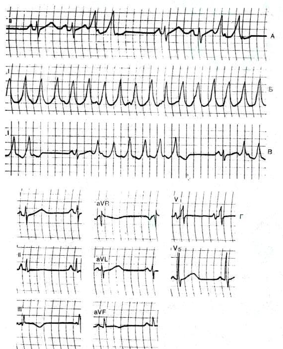 EKG da QRS kompleksi voltaji pasayishi ko rinishidagi o tkir karditning tashxisiy mezoni kasallikning 2-3 hafatalarida ahamiyatga ega.