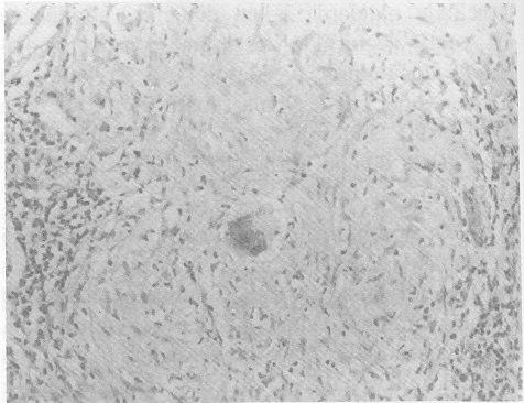 Yusuf KARABULUT ve Ark. taþýr. Sarkoid granülomlarý sitoplazmik inklüzyon cisimcikleri içeren Langhans tipi dev hücrelerle karakterizedir (1,2,7).