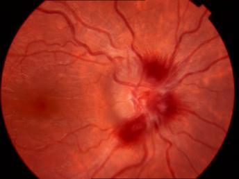 retinal dekolman görülmektedir. ġekil 4.2.