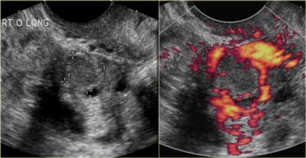 Korpus luteum kisti Transvajinal ultrasonda,power doppler analizinde kist duvarında vaskülarite izlenen küçük