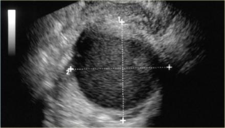 Endometrioma Diğer benign kistik ve kist Kistik endometriozis veya benzeri lezyonlar endometrioma endometrial dokunun yumurtalıklarda büyüdükçe oluşan kist türüdür.