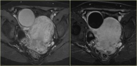 LEFT: Gd-enhanced T1-weighted image