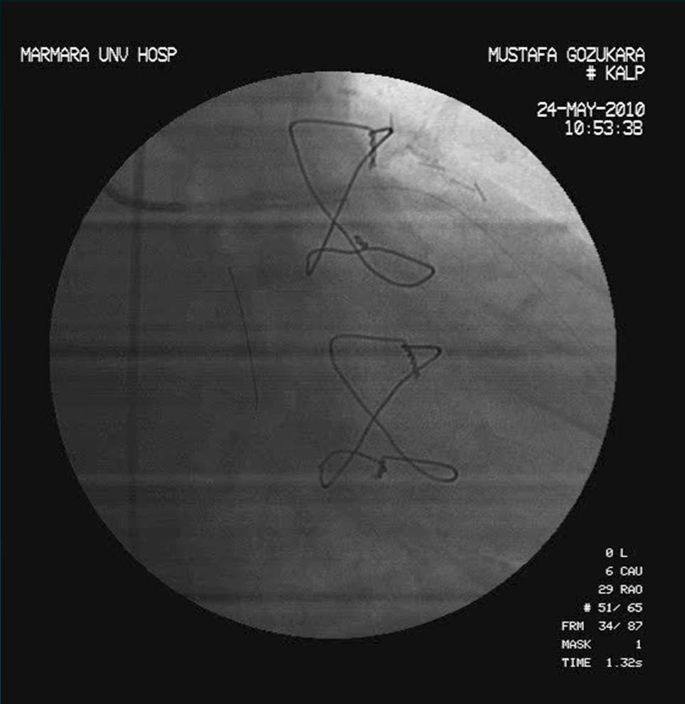 Terumo Runthrough NS hypercooat PTKA kılavuz tel floppy