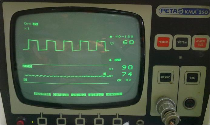 Kateterizasyon ve Monitörizasyon Anestezi altındaki ratların kuyruk ventral arterine heparinize serum fizyolojik (100 Ü/mL) ile yıkanmış 26 gauge kanül (Becton Dickinson Infusion Therapy AB SE-251 06