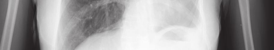 pulmoner arter ve parankimin olmaması (akciğer aplazisi) 3- Değişik oranlarda parankim varlığında, bronş ve pulmoner arterin az gelişmesi (akciğer hipoplazisi).