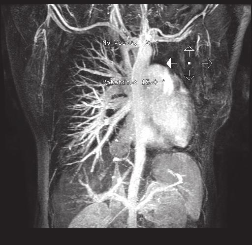 Sol akciğerde pulmoner vasküler yapıların yokluğu dikkat çekti. Sol akciğerde küçük bir akciğer parankimi izlendi (Resim 3).
