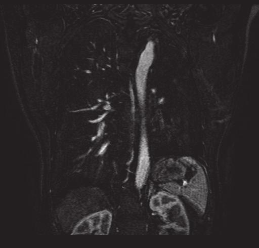 Toraks MR anjio da normal sağ pulmoner arter ve hipoplazik sol pulmoner arter görünümü bulunuyor. TARTIŞMA Resim 3.