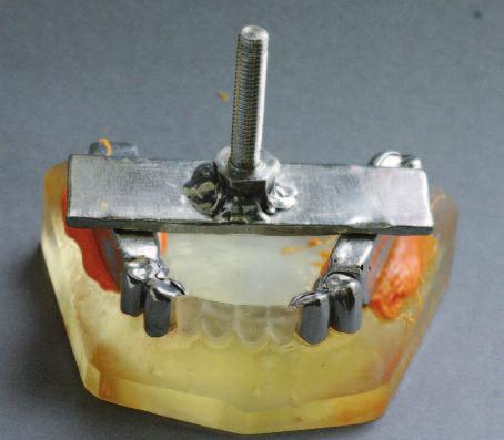 turkiyeklinikleri.com/) yerleştirildikten sonra Cr-Co (Remanium GM 800+; Dentaurum, Ispringen, Almanya) dental döküm alaşımından metal kronlar elde edildi (Resim 2).