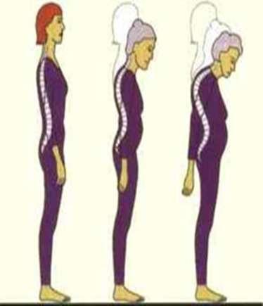 Osteoporoz, düşük kemik kitlesi ve kemik dokusunun mikromimari yapısının bozulması sonucu