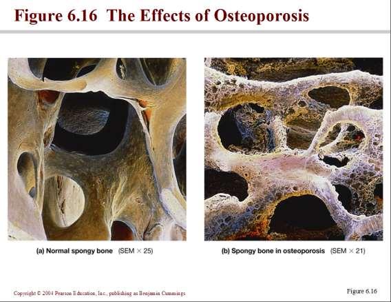 Osteoporoz yaşlanmayla artan fizyolojik bir olaydır.