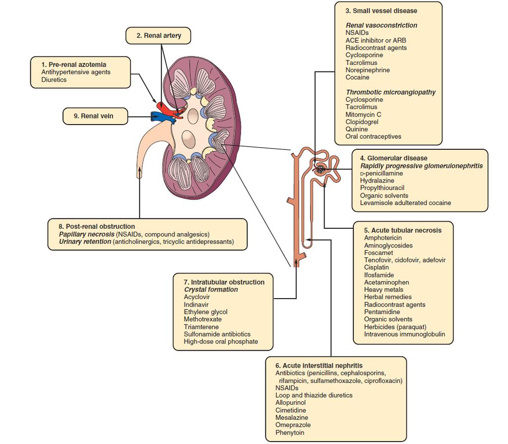 Prerenal azotemi Antihipertansif ilaçlar Diüretikler Renal ven ven Renal arter Postrenal obstrüksiyon Papiller nekroz (NSAİD, birleşik analjezikler) İdrar retansiyonu (antikolinerjikler, trisiklik