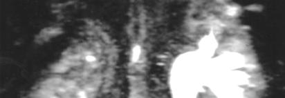 Serviks karsinomlu bir olguda, İVP ile götserilemeyen sol üreter dilatasyonu MR ürografi ile ortaya konuldu.