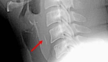 Spiral tomografi Bronkoskopi İnhalasyon yaralanmaları Genelde kapalı alan yangınlarında görülür