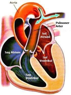 Ventriküllerin diastolünde Diastolik üfürüm PDA da Aorta hem sistol hem de diastol