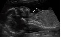 Neonatal tirotoksikoz (NT) Ge elik sırası da USG ile takip; Fetal guatr ve taşikardi IUBG - SGA ve preterm doğu Ağır olgularda IU kalp et ezliği, fetal hidrops, IU ölüm Postnatal klinik özellikler;