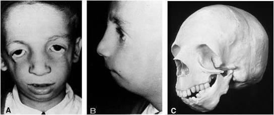 Şekil 10 Hemifasial Mikrosomia (Şekil 11) Her zaman tek taraflıdır Dış kulak deformasyonu, mandibula ve squamoz temporal kemikte deformasyon %7-22