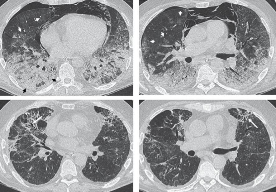 Sarı RA. 367 a Şekil 8. Dermatomiyozit tanısı olan bir hastada diffüz alveoler hasar (DAD)/Organize pnömoni olgusu. A-B; yaygın buzlu cam alanları ile birlikte yoğun konsolide alanlar.