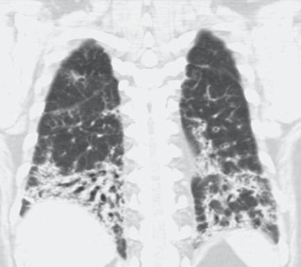 368 Kollajen Doku Hastalıklarında İnterstisyel Akciğer Hastalığı / Interstitial Lung Diseases In Collagen Vascular Diseases SJÖGREN SENDROMU Sjögren sendromu (SS) primer ve sekonder olmak üzere iki