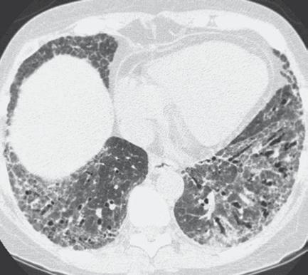 362 Kollajen Doku Hastalıklarında İnterstisyel Akciğer Hastalığı / Interstitial Lung Diseases In Collagen Vascular Diseases Şekil 4. Sistemik sklerozda NSIP paterni. ları olmasa da görülebilir.