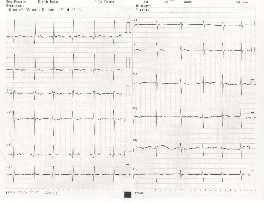 EKG