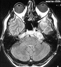 C D E Resim 3. Olgu 8. Sol orta kranyal fossa yerleflimli epidermoid tümör. A.