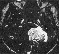 FLAIR sekans nda tümör 2 olguda OS a göre hafif hiperintens (Resim 2,D; 3C), 1 olguda izointens olarak izlendi.
