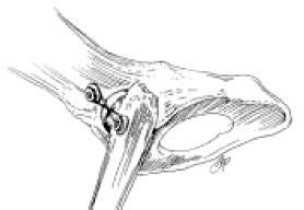 28 kemik tutma pensi ile femur un proksimal kısmı kavranarak eklem redükte edilir (McLaughlin, 1995; Holsworth ve DeCamp, 2002).