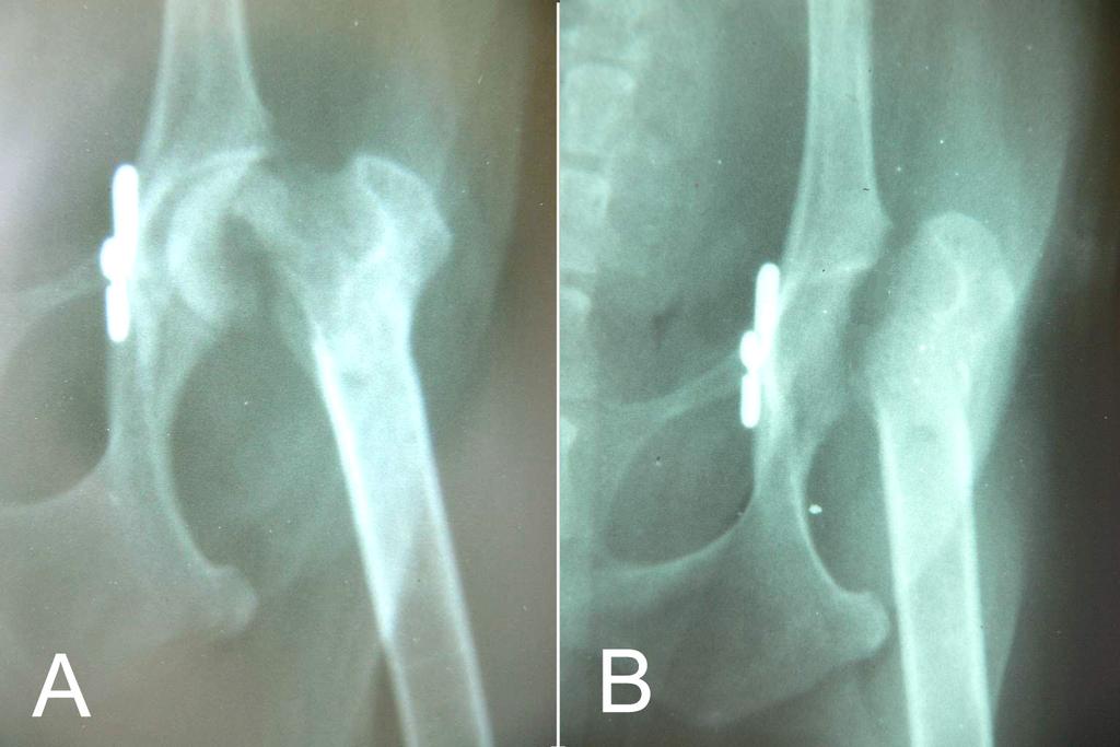 61 femur un proksimal inde kaldığı 25. olgu da, bu durumla ilgili olumsuz bir durum belirlenmedi. Şiddetli topallık şikâyeti ile postoperatif ikinci ayda kliniğimize getirilen 8.