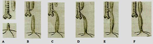 Şekil 1: Özofagus atrezisinde Gross un anatomik sınıflandırması (1). Kardiak anomalilerden en sık ventriküler septal defekt görülür.