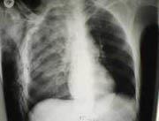 Akciğer kontüzyonu (EN SIK) Akciğer hemorajisi ve